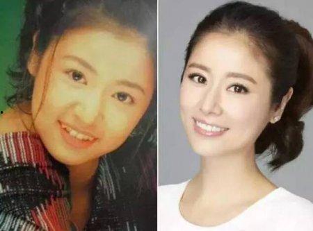 明星整牙,揭秘整牙前后颜值大逆袭